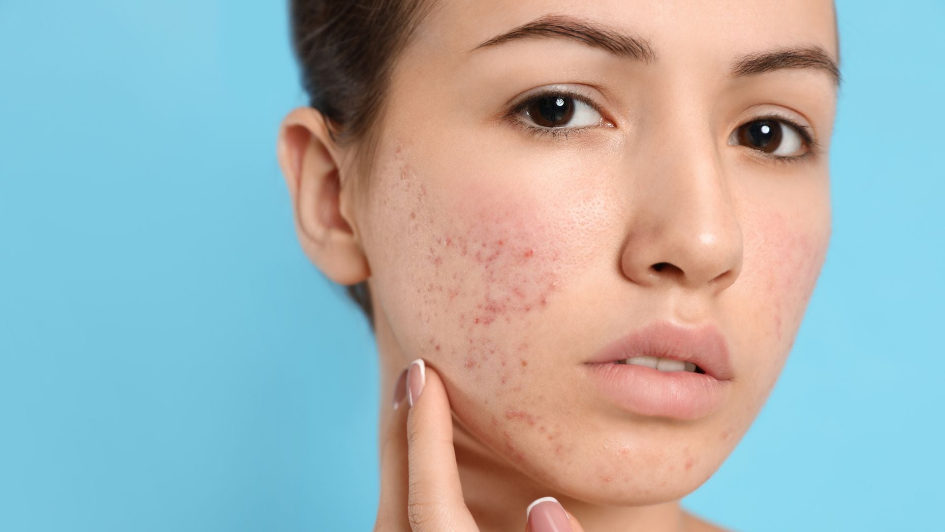 Why Your Acne Scars Aren't Healing: The Hidden Secrets to Finally Fixing Your Skin