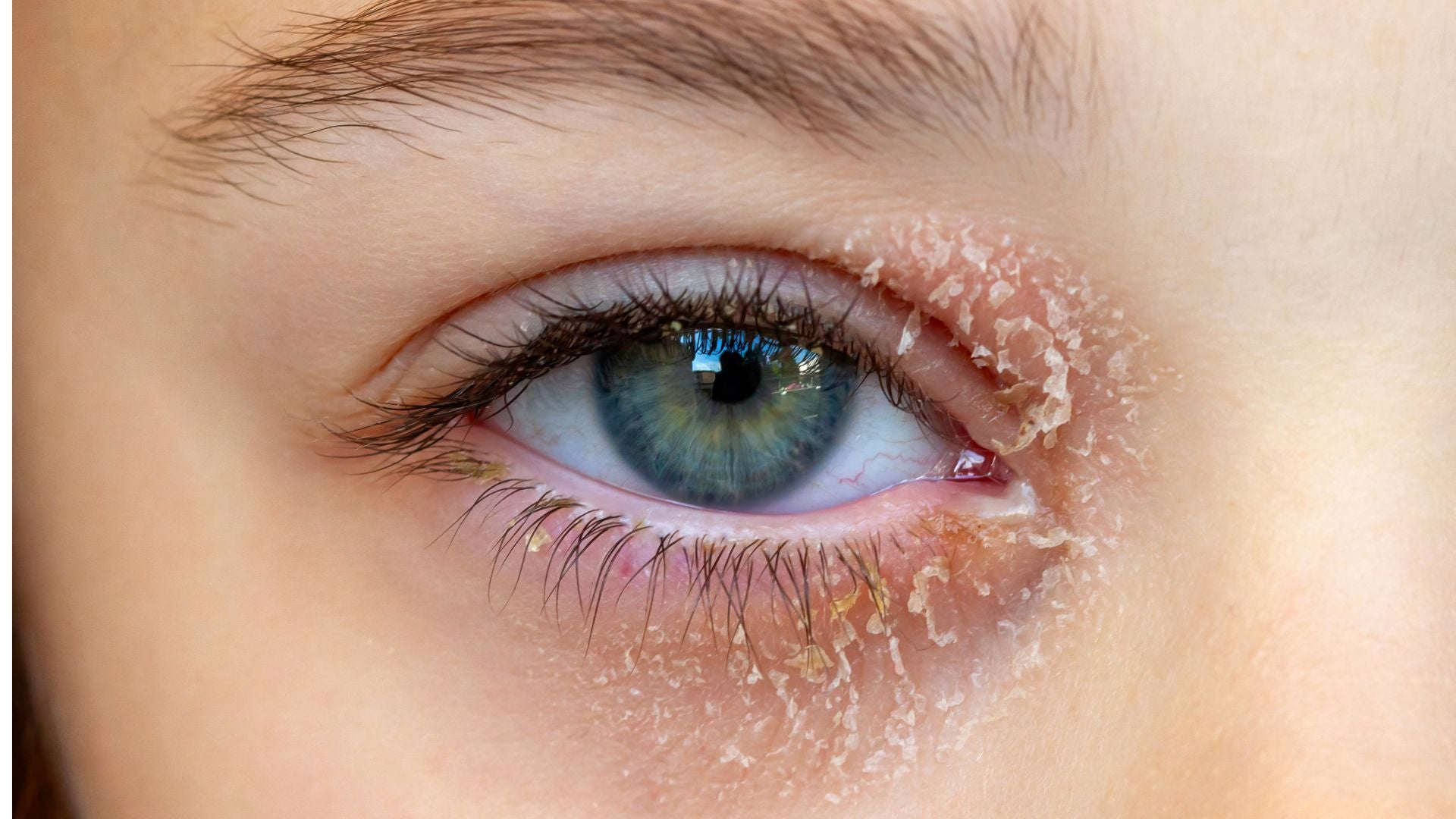 Say Goodbye to Irritated Eyelids: The Surprising Secret to Soothing Eczema and Blepharitis Naturally