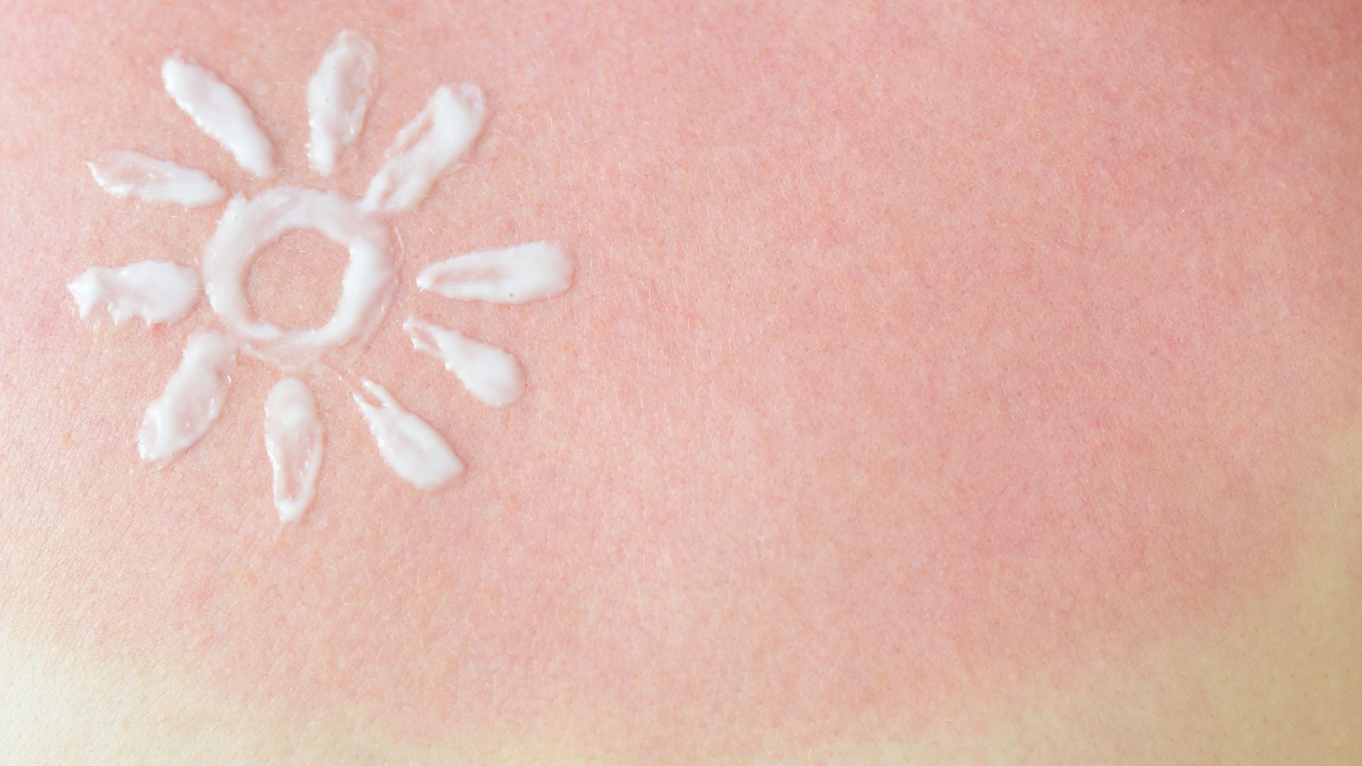 The Sunburn Soothing Secret You Need This Summer