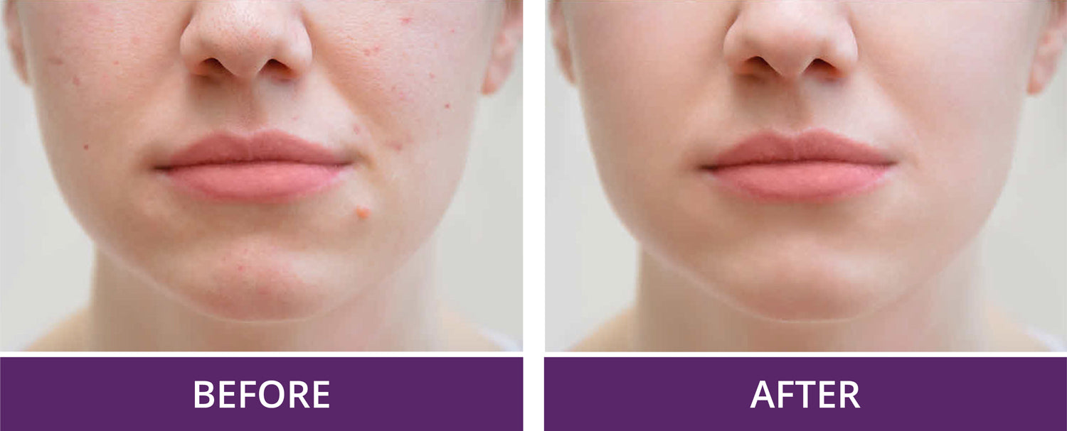 Before and after picture of how silk helps people with acne